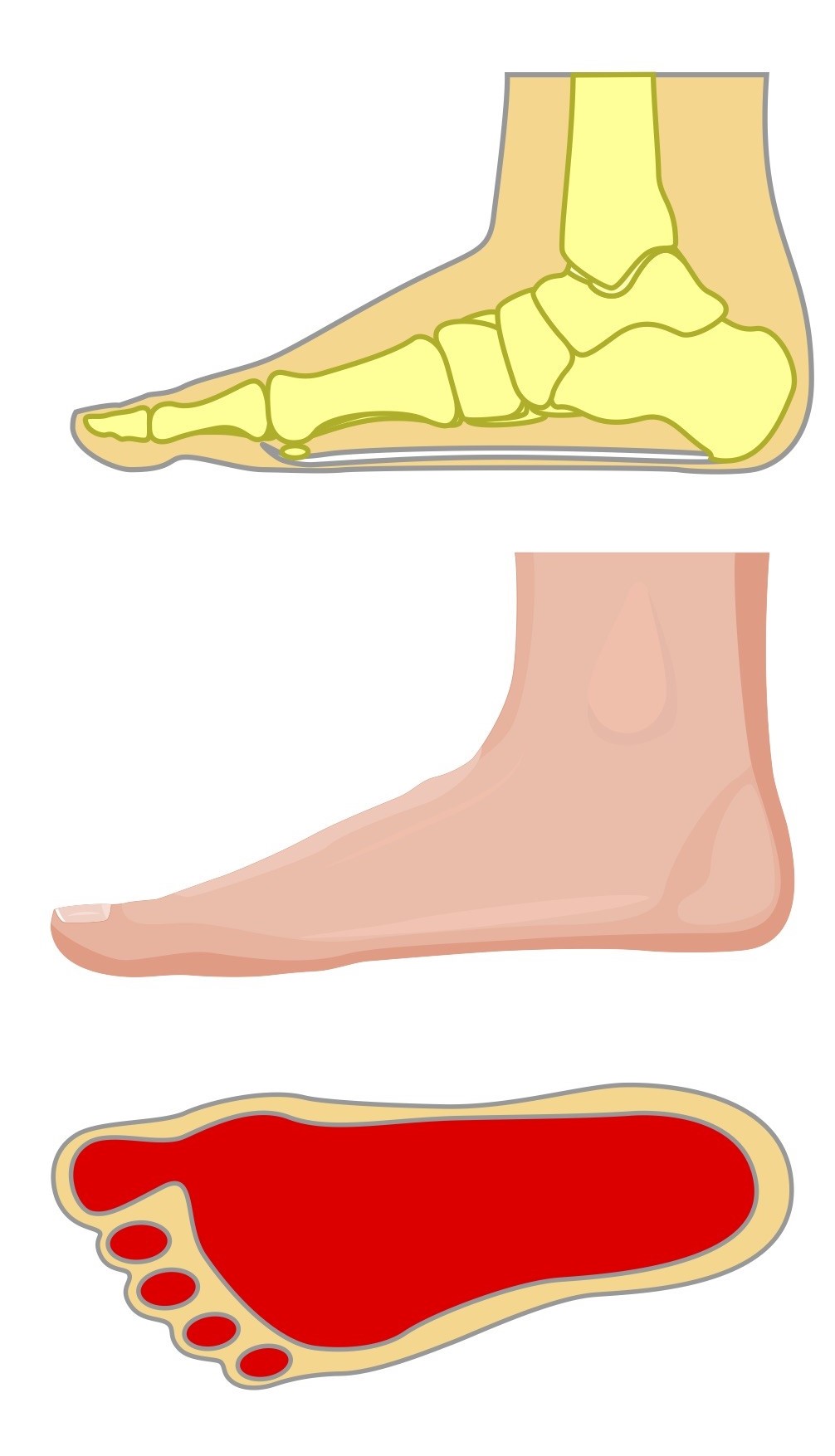 Platvoet (pes planus)